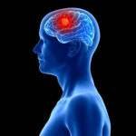 Medical illustration showing a blue head and neck with a red brain tumor highlighted inside the brain, viewed from the side.