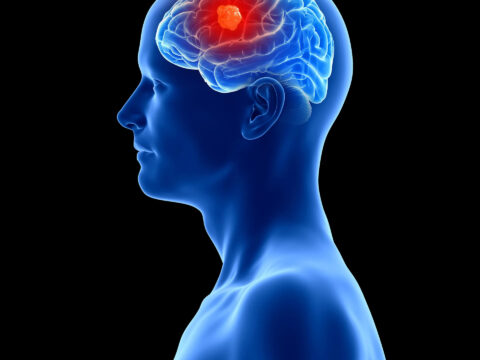 Medical illustration showing a blue head and neck with a red brain tumor highlighted inside the brain, viewed from the side.